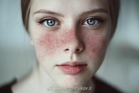 لوپوس در كمین زنان